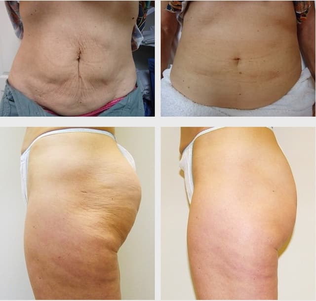 Cellulite treatments to smooth skin texture.